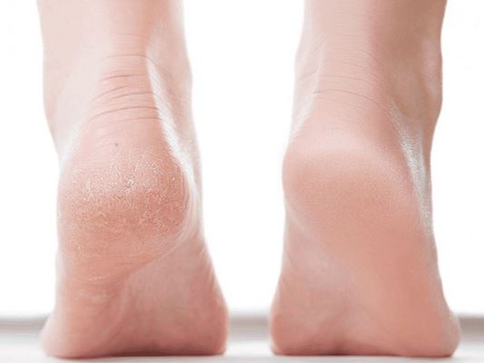 راهکارهای خانگی درمان پا‌های ترک خورده