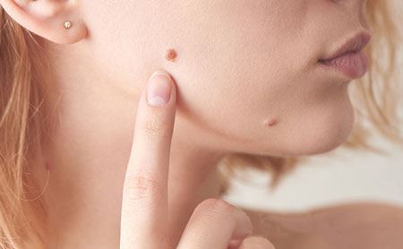 خال اپیدرمال:علل، علایم و درمان آن