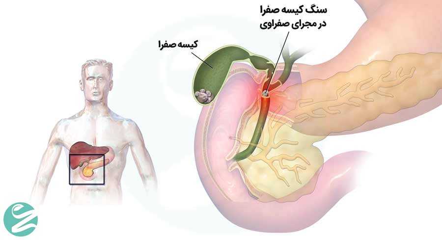 از بین بردن سنگ کیسه صفرا