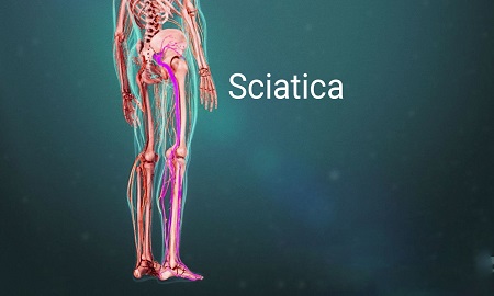 درمان پارگی دیسک کمر, پارگی دیسک کمر چه علائمی دارد, علایم پارگی دیسک کمر و درمان