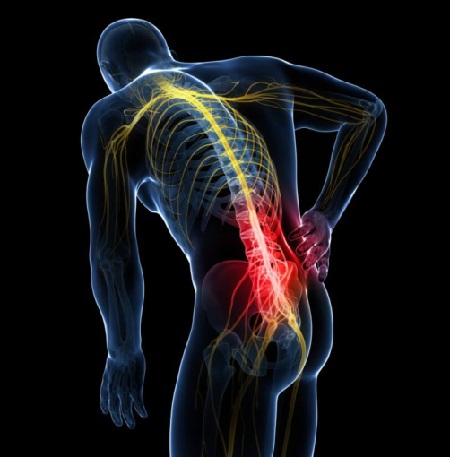 درمان پارگی دیسک کمر, پارگی دیسک کمر چه علائمی دارد, علایم پارگی دیسک کمر و درمان