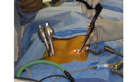 راه های درمان پارگی دیسک کمر, علل پارگی دیسک کمر, عوارض پارگی دیسک کمر