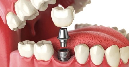 اصلاح فاصله بین دندان ها با ارتودنسی, بستن فاصله بین دندان ها, کامپوزیت برای پر کردن فاصله دندان ها