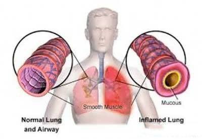 درمان برونشیت با برگ انجیر