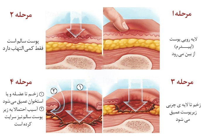 مراحل بیماری زخم بستر