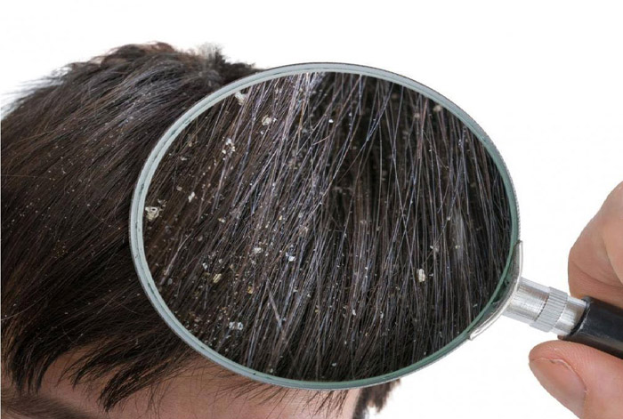 شوره سر و شامپو ضد شوره