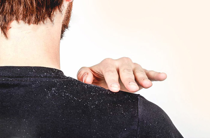 راهنمای انتخاب شامپو ضد شوره