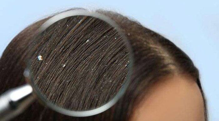 درمان ضوره با شامپو ضد شوره