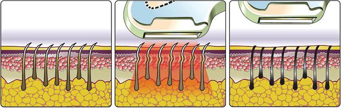 نحوه عملکرد دستگاه لیزر خانگی