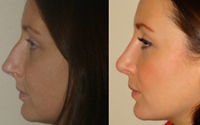 لیفت بینی با نخ