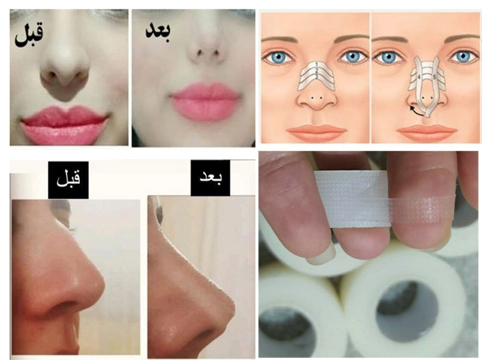 چسب لیفت بینی قبل و بعد