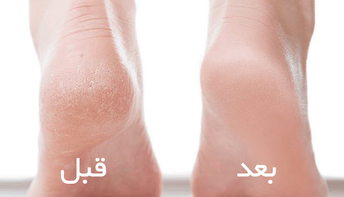 نتیجه استفاده از کرم ترک پا