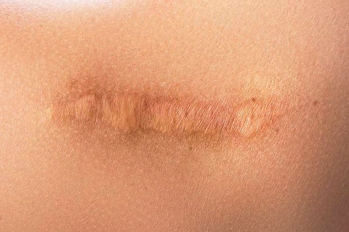 بهبود بخیه زایمان